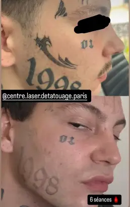 Détatouage Pico Laser du Visage Paris