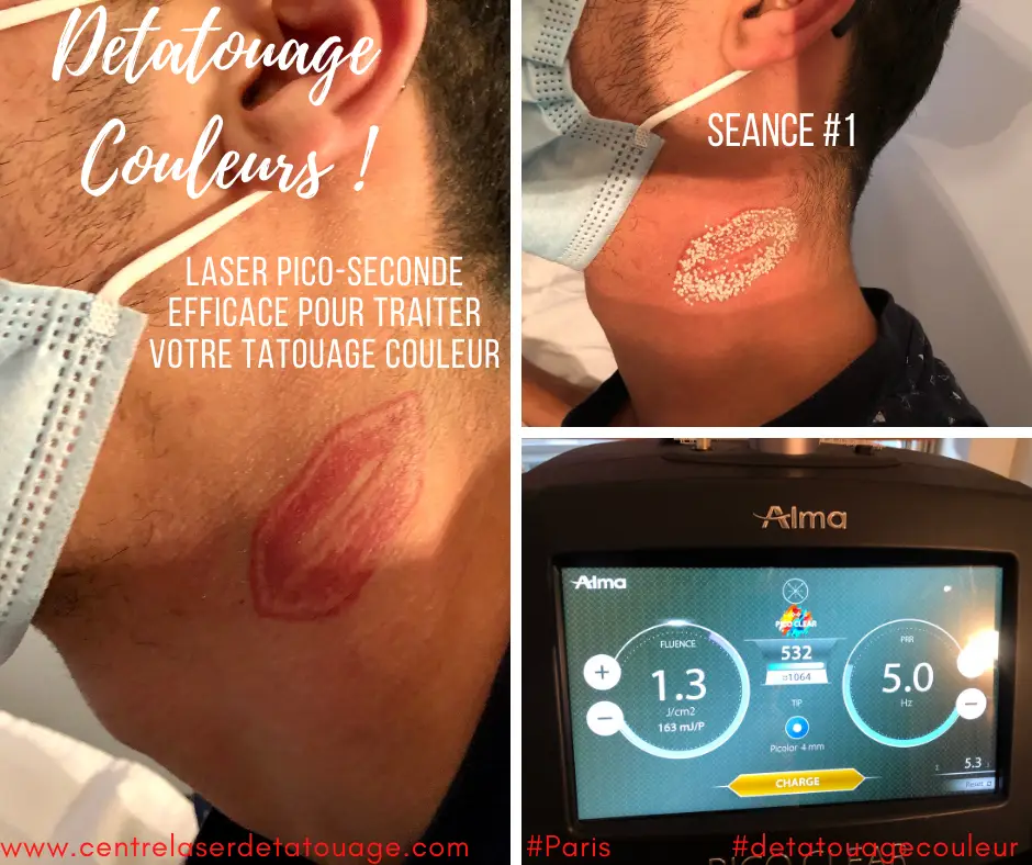 Centre Detatouage - Laser Détatouage & Esthétique Paris