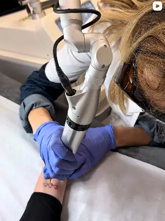 Détatoage au Pico Laser