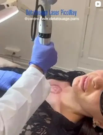 Centre Détatouage à Paris un Laser Journal à Paris