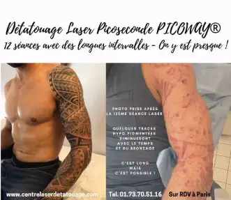 Laser Détatouage & Esthétique Paris