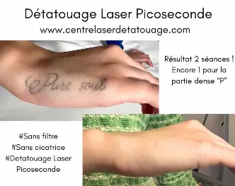 Détatouage à Paris chez Centre Laser Detatoage & Esthetique Paris