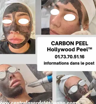 Centre Laser Détatoage & Esthétique Paris Presente Carbon Peel