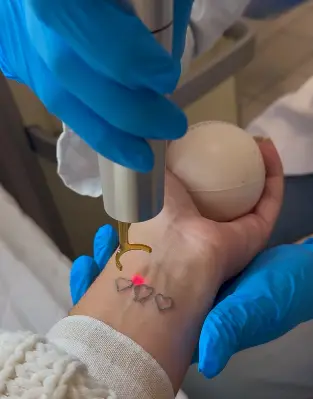 Détatouage